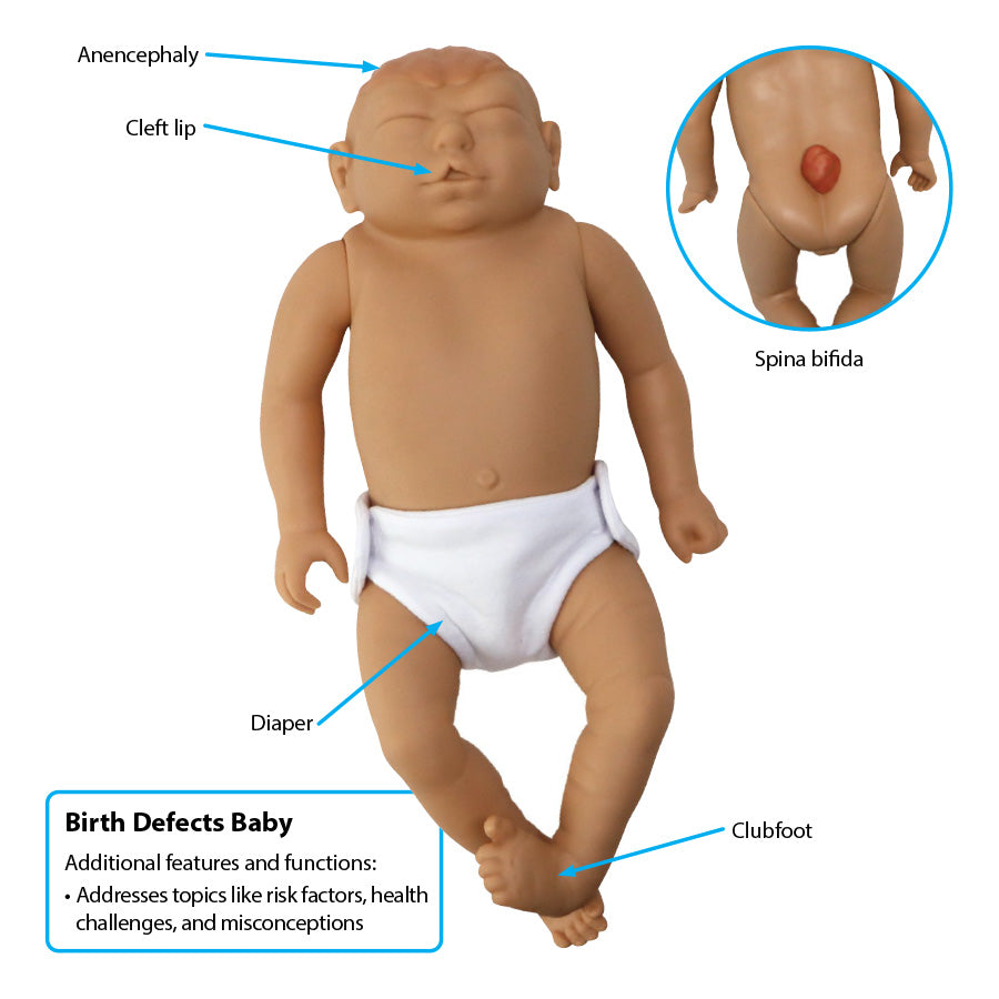 Birth Defects Baby