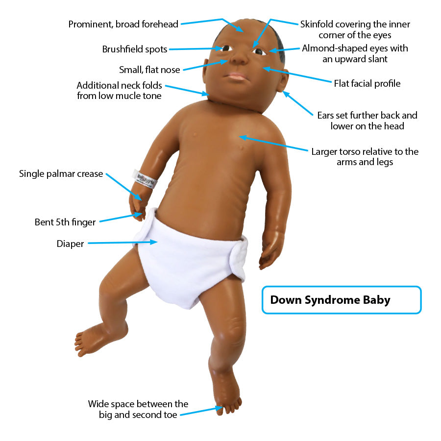 Down Syndrome Baby