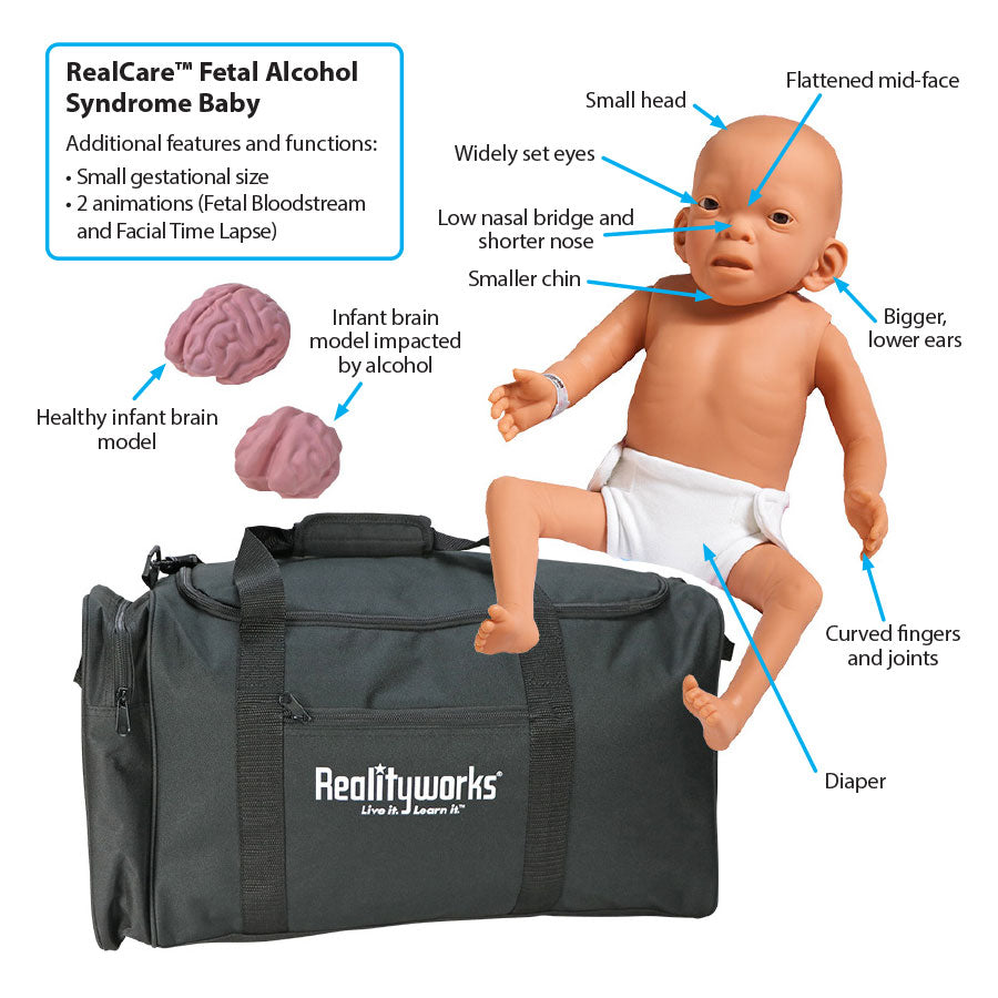 Fetal Alcohol Syndrome Baby