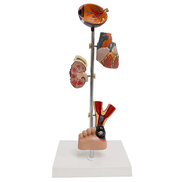 Diabetes Type II Model